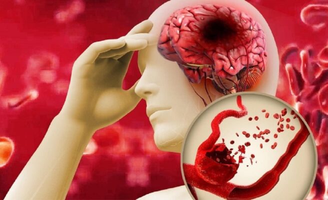 Đột quỵ không báo trước – nhưng cơ thể bạn thì luôn lên tiếng, nếu bạn biết cách lắng nghe